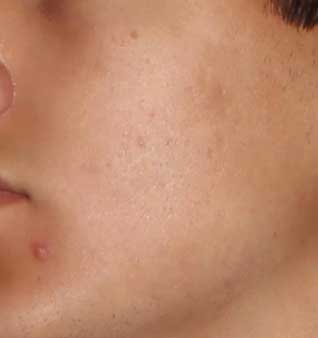 Severe Acne Treatment - After