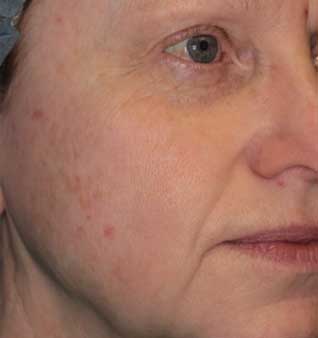 Acne Scars Treatment - After