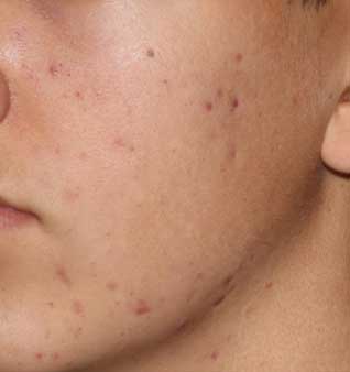 Severe Acne Treatment - Before