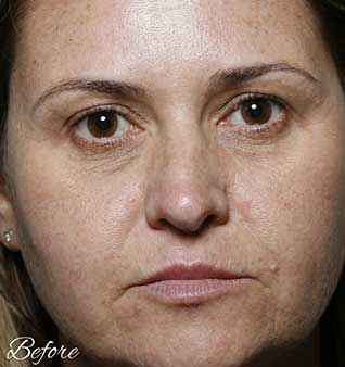 Wrinkles and Fine Lines Treatment
