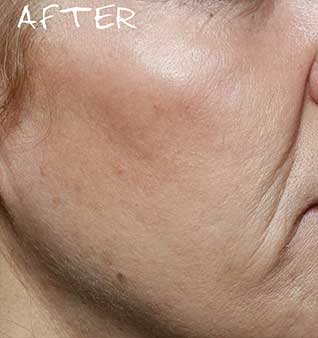 Facial Volume Loss Treatment - After