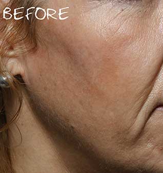 Facial Volume Loss Treatment - Before