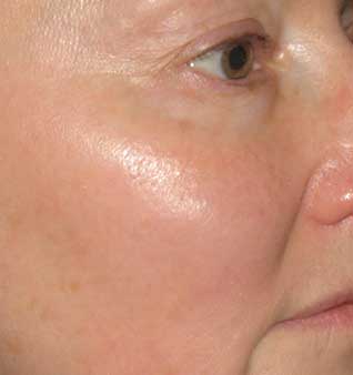 Rosacea Remedies and Skin Redness Treatment - After