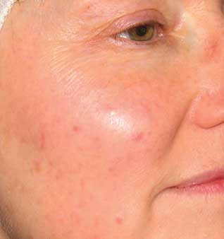 Rosacea Remedies and Skin Redness Treatment - Before