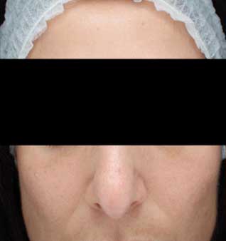 Rosacea Remedies and Skin Redness Treatment - After