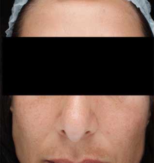 Rosacea Remedies and Skin Redness Treatment - Before