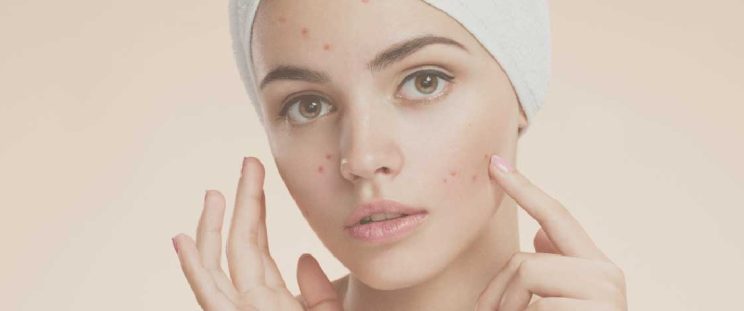 Pimples and the cure, an APT Medical Aesthetics blog