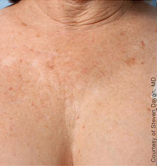 Ultherapy before and after photos of chest