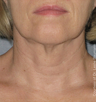 Ultherapy® Treatment - After