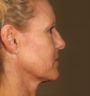 Ultherapy® before and after photos of chin