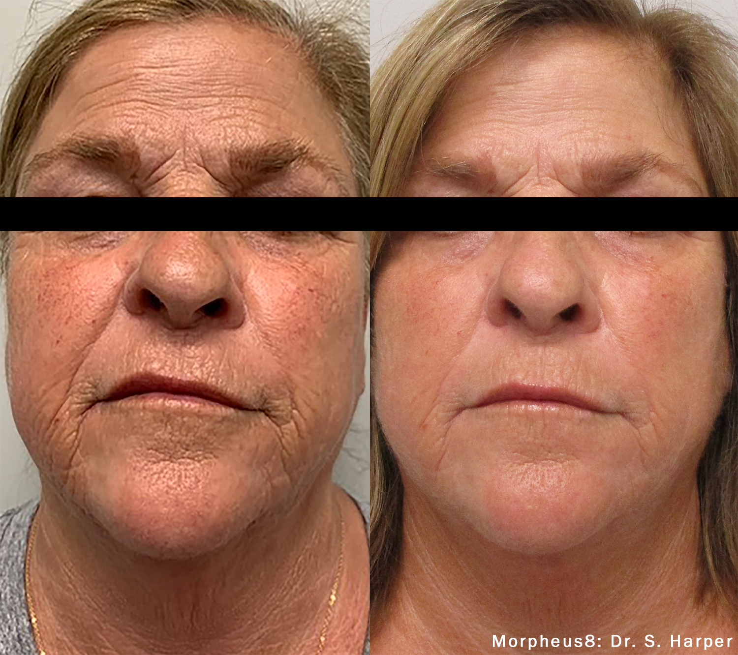 Morpheus 8, Mircroneedling with Radiofrequency, Morpheus8 benefits, Morpheus8 results