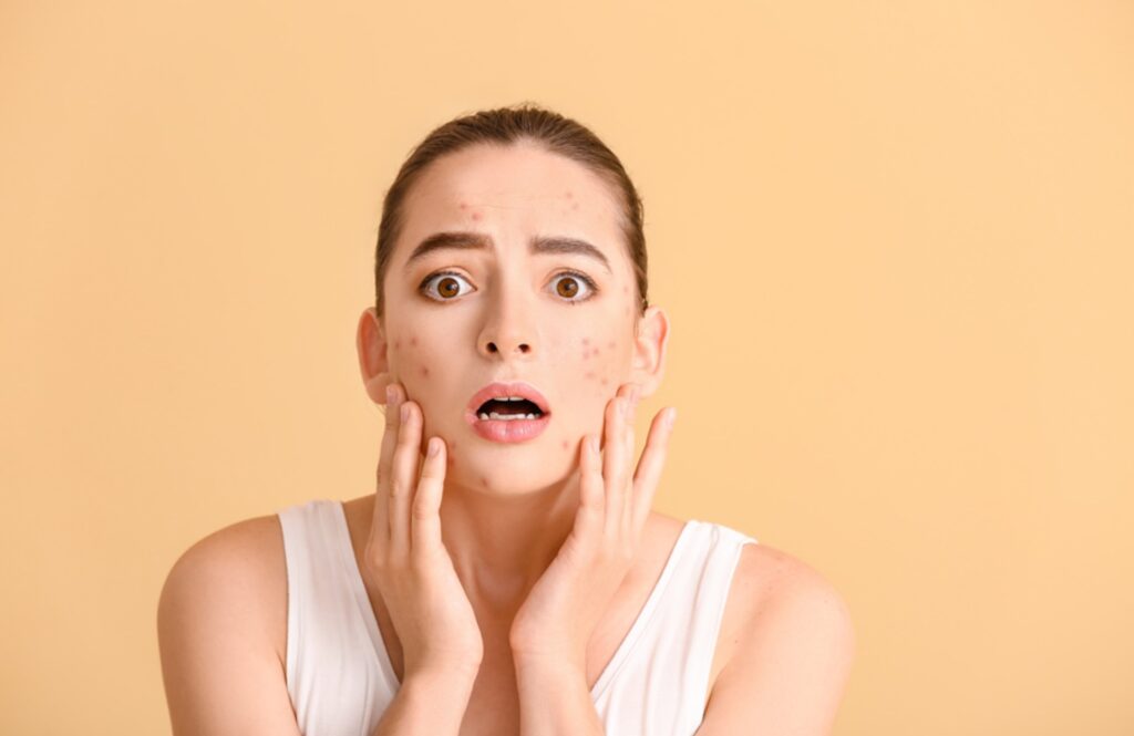 China Pimples Exploding Why You Get Chin Pimples and What They Reveal About Your Skin - APT